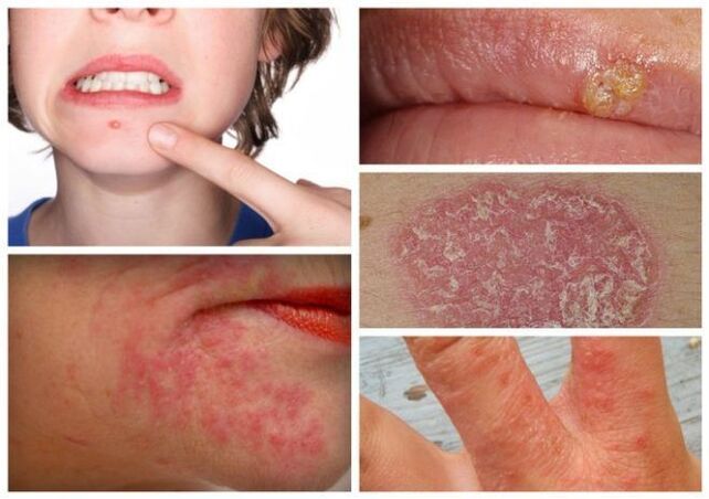 Alergiile și bolile de piele sunt semne ale paraziților din organism