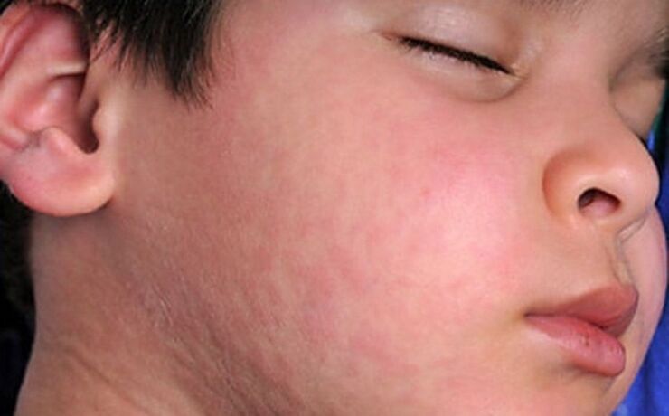 Erupții alergice pe piele - un simptom al prezenței viermilor paraziți în organism